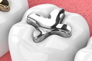 Amalgam Fillings