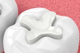 Glass Ionomer Fillings