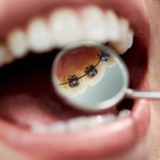 A close up image of a dentist inspecting the braces of a patient that is behind their teeth.