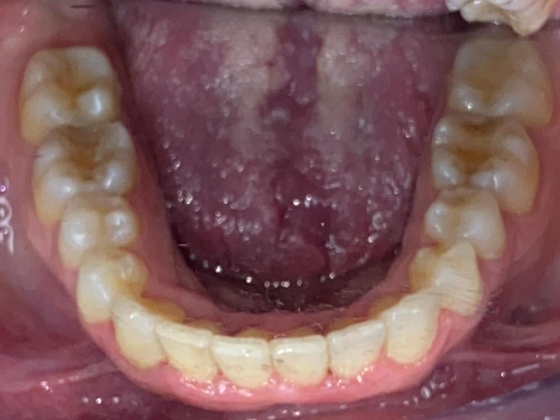 Braces and Invisalign -After
