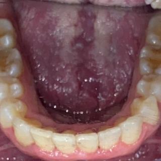Braces and Invisalign -After
