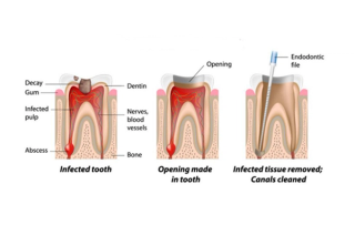 Image of the first three stages of a root canal procedure.