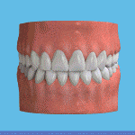 Gif image on how dental crowns are installed.