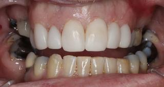 Veneers 1 - After