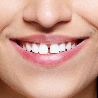 What Can a Smile Makeover Address?