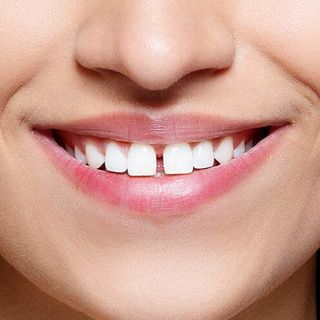 Gaps between teeth