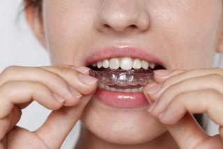 Clear Aligners