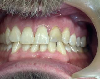 Jed before crown and bridge treatment.