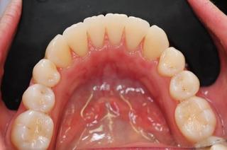 Clear Aligners 1 - After