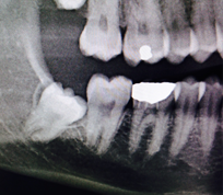 Problematic wisdom teeth