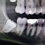 Problematic wisdom teeth