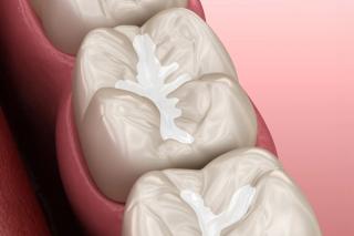 Fissure sealants at Wyndham Dental Solutions
