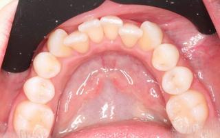 Clear Aligners 1 - Before