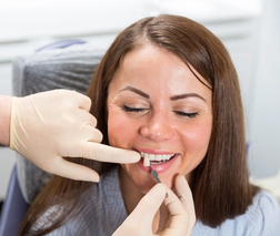 4. Veneer Placement