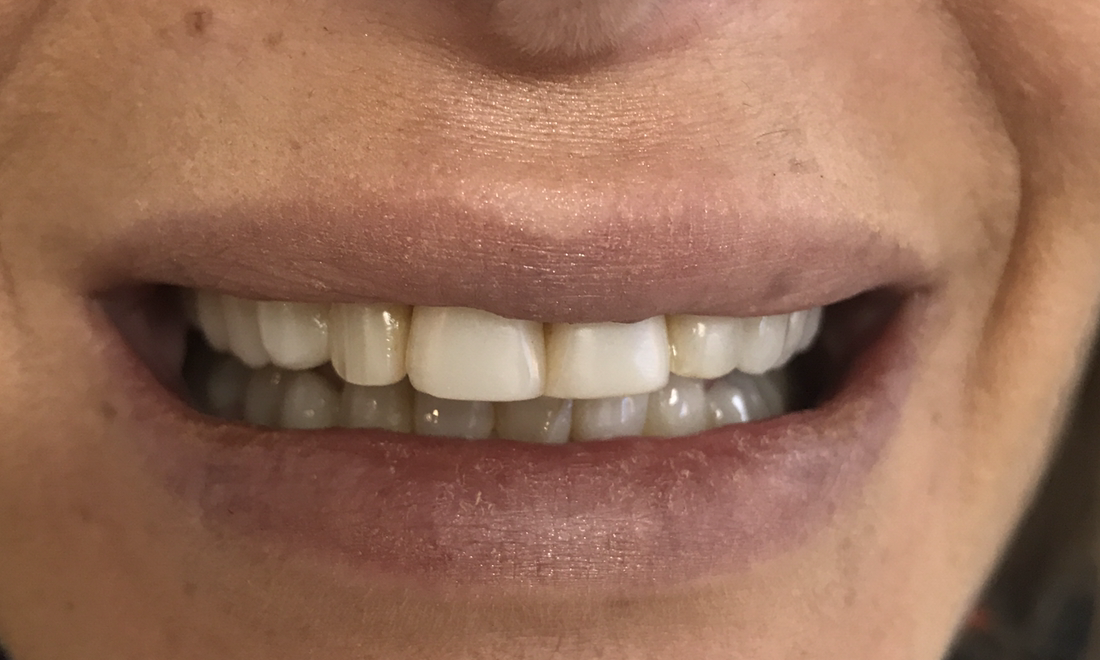Cosmetic Dentistry - Before