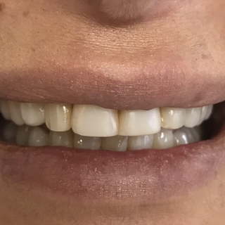 Cosmetic Dentistry - Before