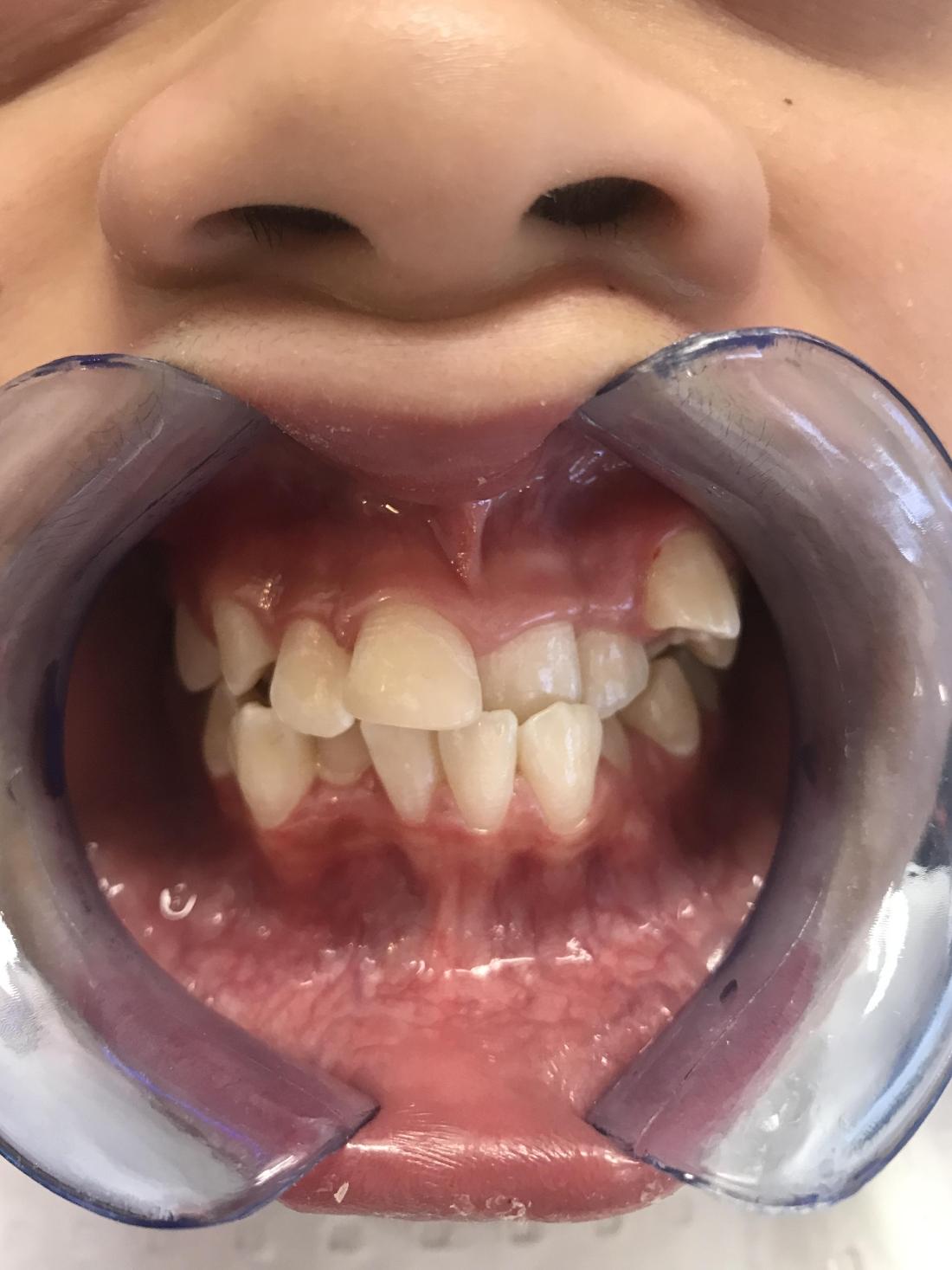 Braces and Invisalign - Before