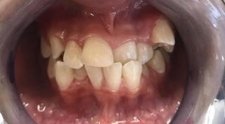 Braces and Invisalign - Before