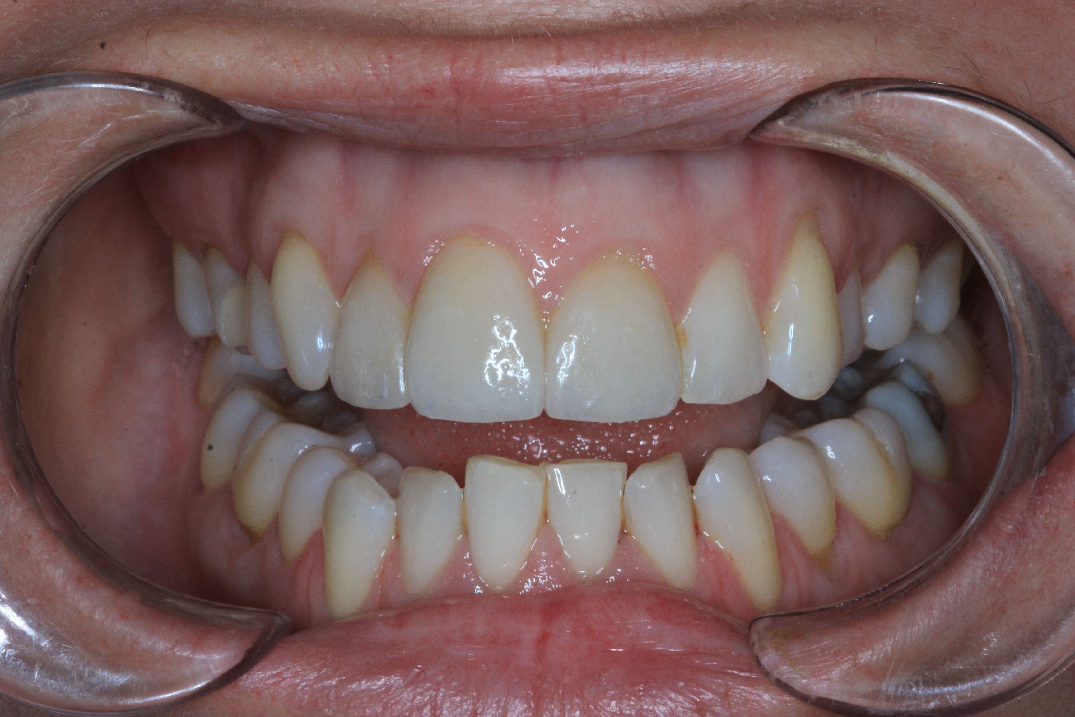 after veneers