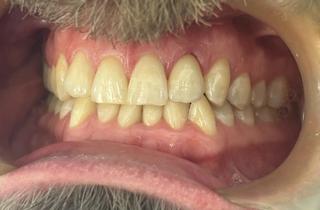 Jed after crown and bridge treatment.