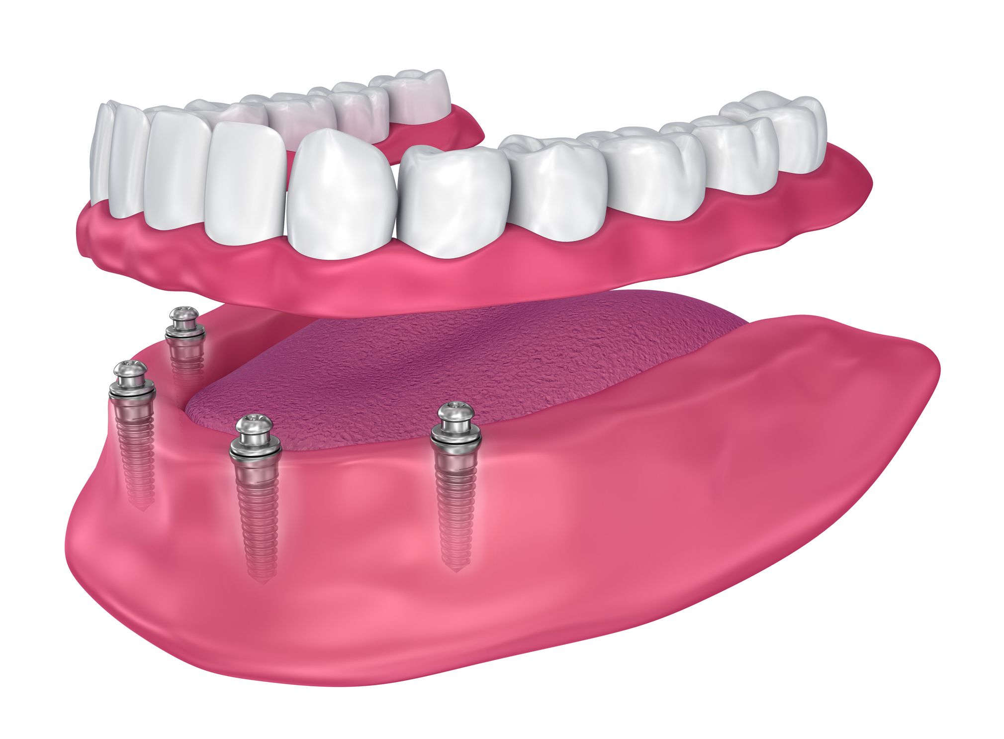 Implant-Retained Dentures
