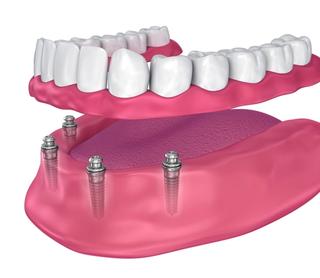 Implant-Retained Dentures