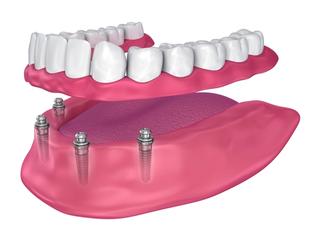 implant-retained dentures
