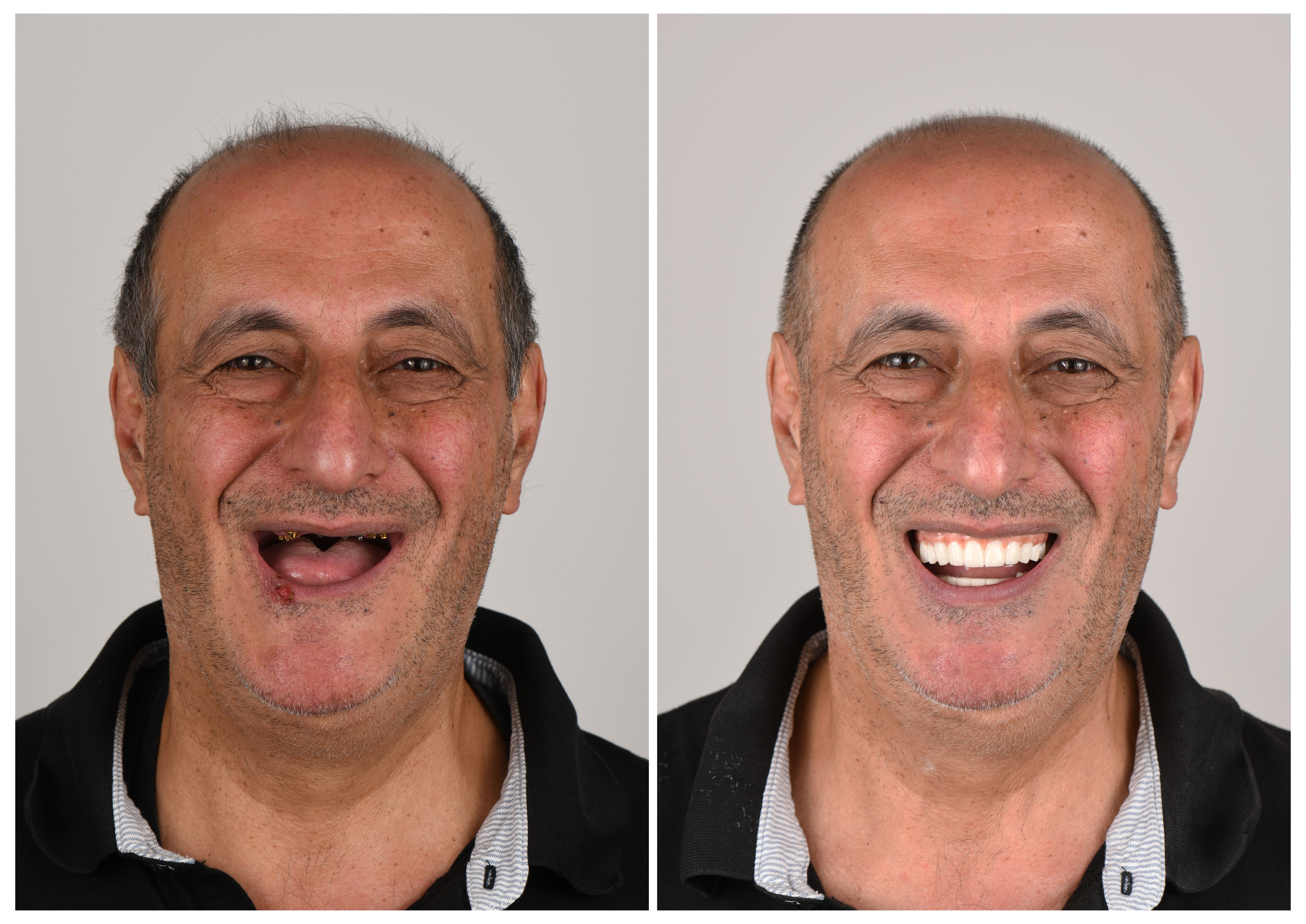 Example stock image of a denture before and after (not a patient from our clinic)