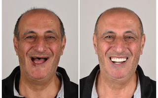 Example stock image of a denture before and after (not a patient from our clinic)