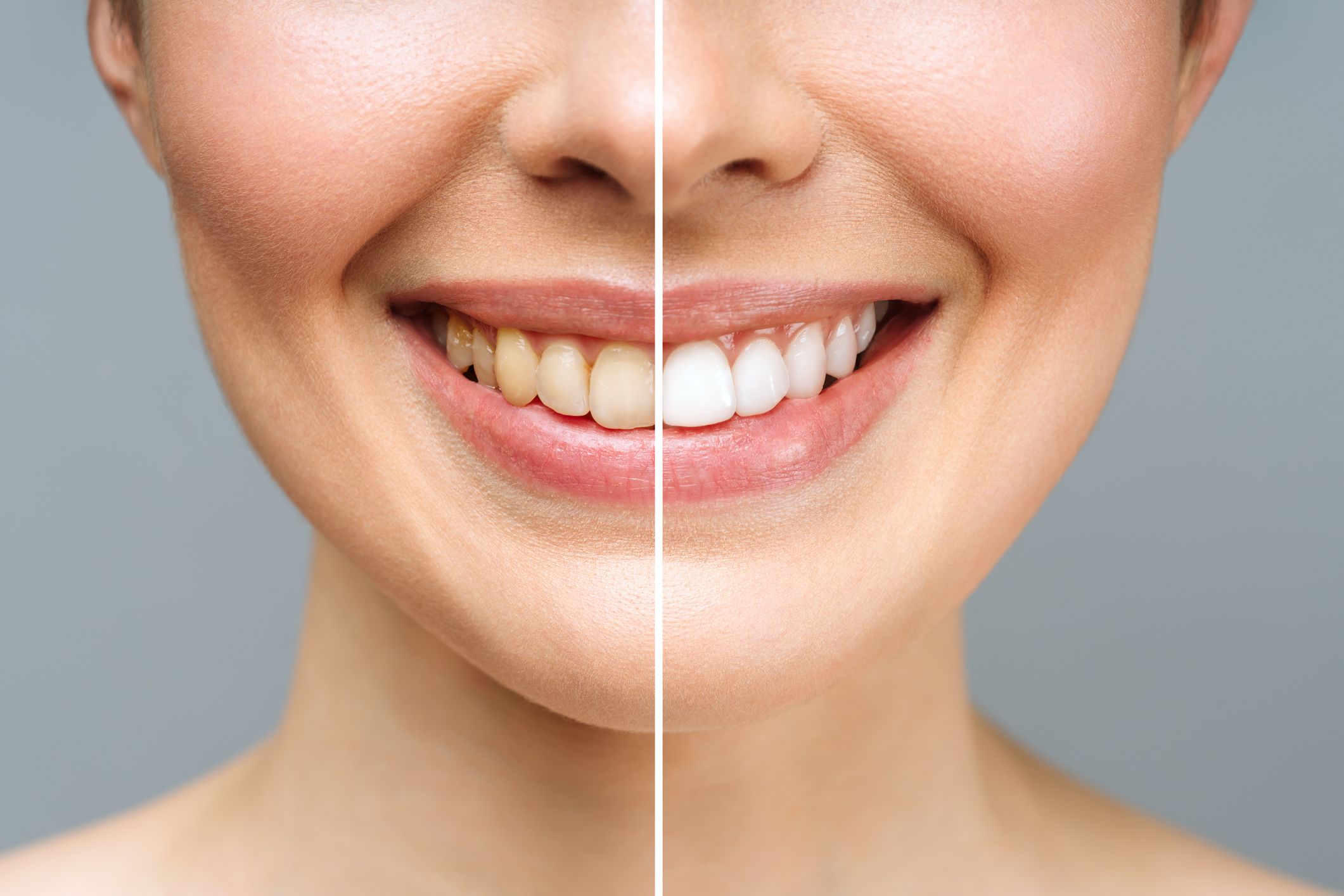 Image of a comparison between white teeth and yellowed teeth on a female model.