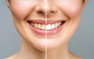 Before and after comparison of teeth whitening