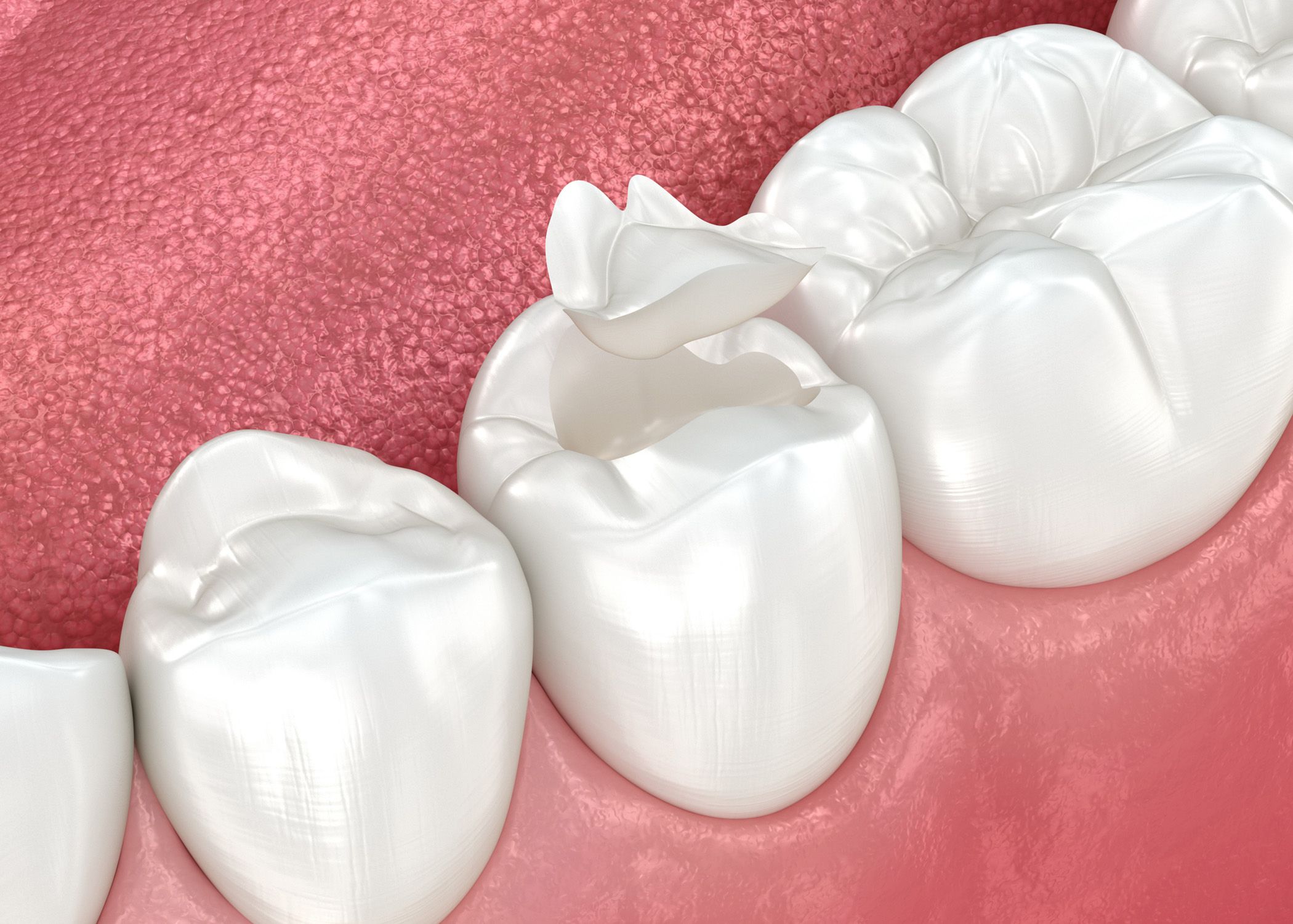3D render of an dental inlay. 