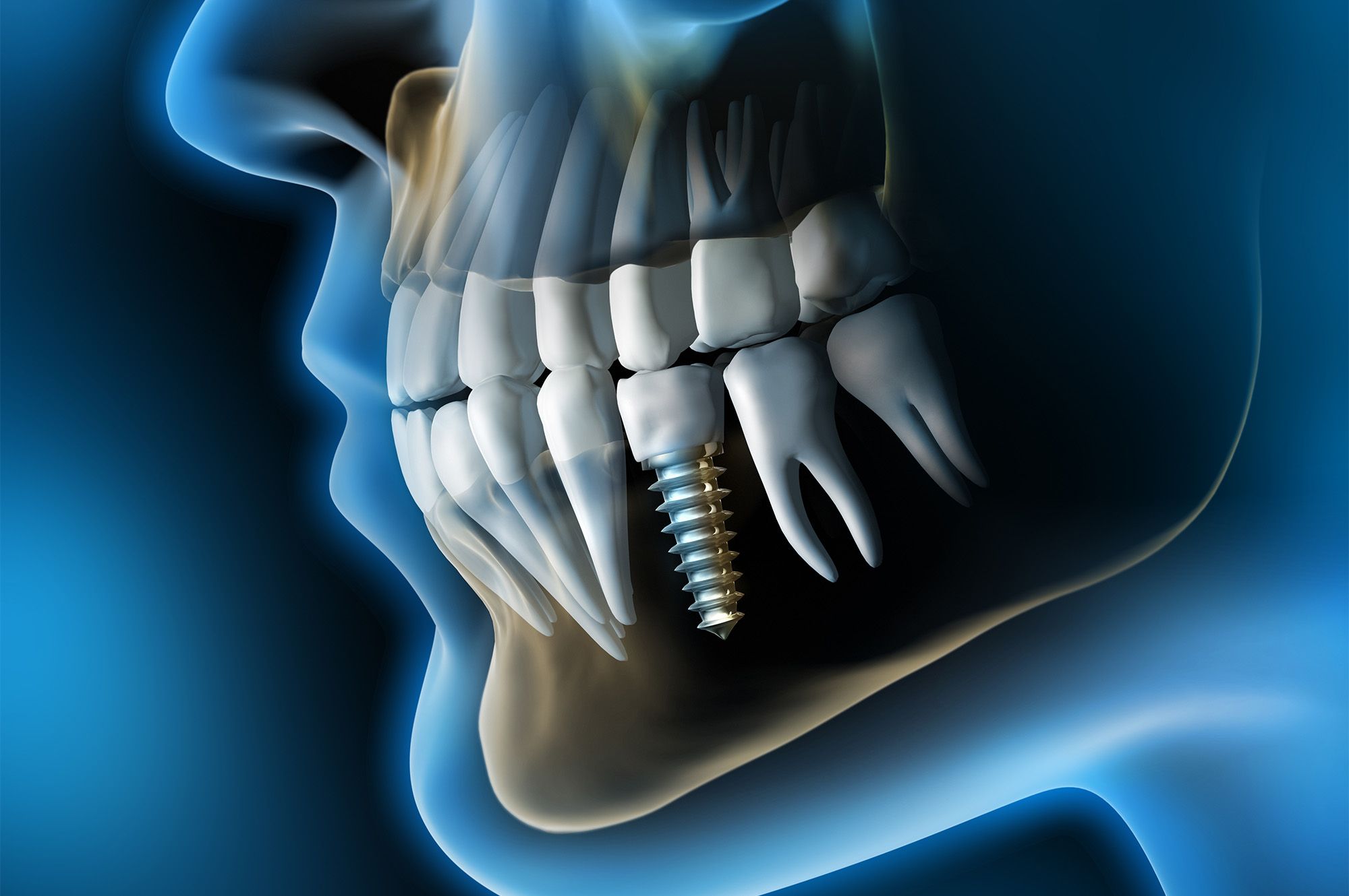Who Qualifies for Dental Implants?