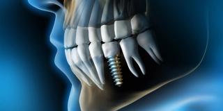 Who Qualifies for Dental Implants?