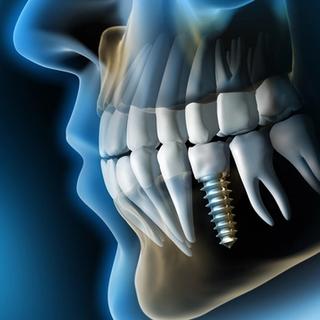 The Implant Brands We Use
