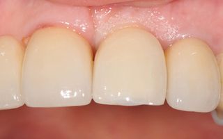 A completed example of a dental implant in Richmond, Melbourne