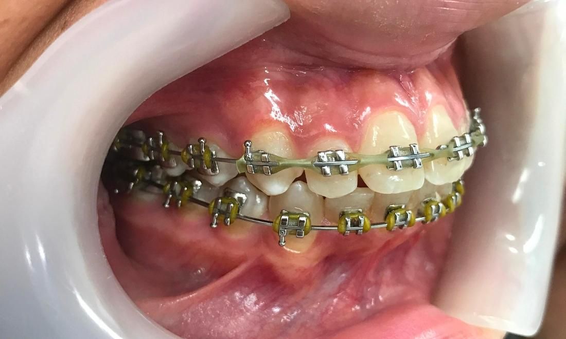 Braces and Invisalign - After - Left Side