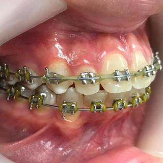 Braces and Invisalign - After - Left Side
