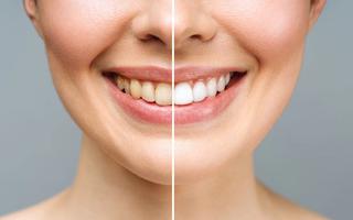 Stock image: Example before and after photo post whitening treatment