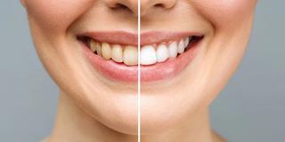 Dental Teeth Bonding Treatment - Hero