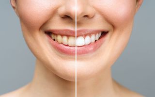 Stock image: Example before and after photo post whitening treatment