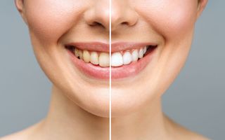 Teeth whitening results before and after
