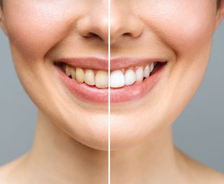 Why Your Teeth Discolour Over Time?