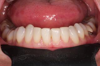 Clear Aligners 2 - After