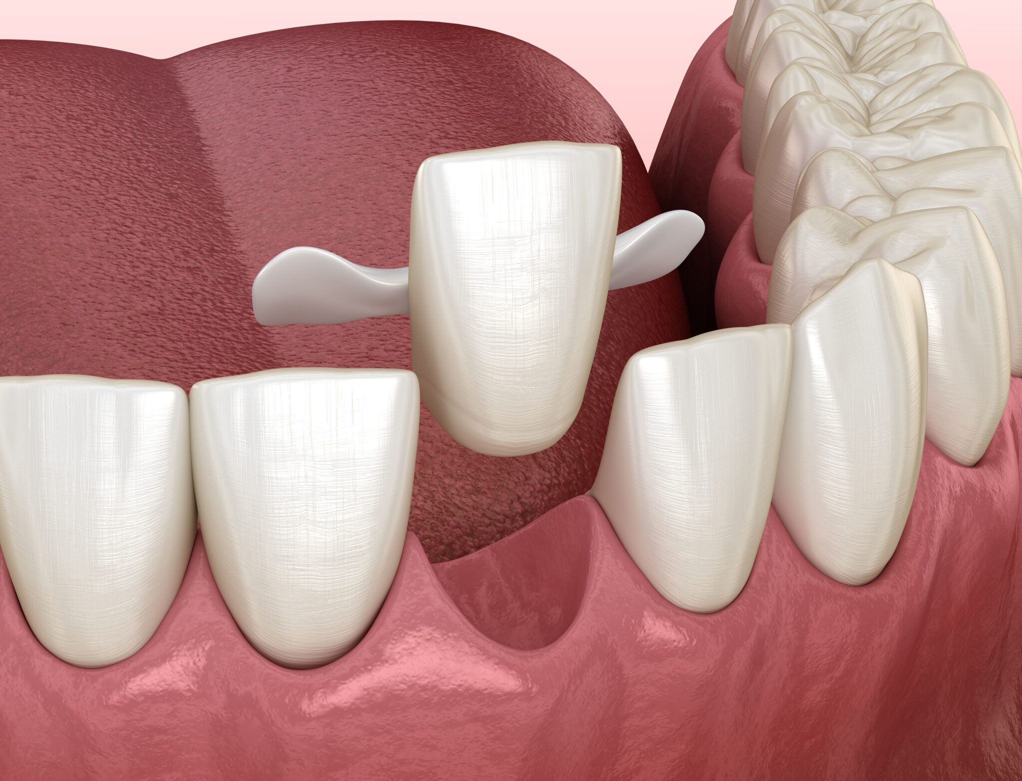 Maryland Dental Bridge