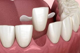 Maryland Dental Bridge