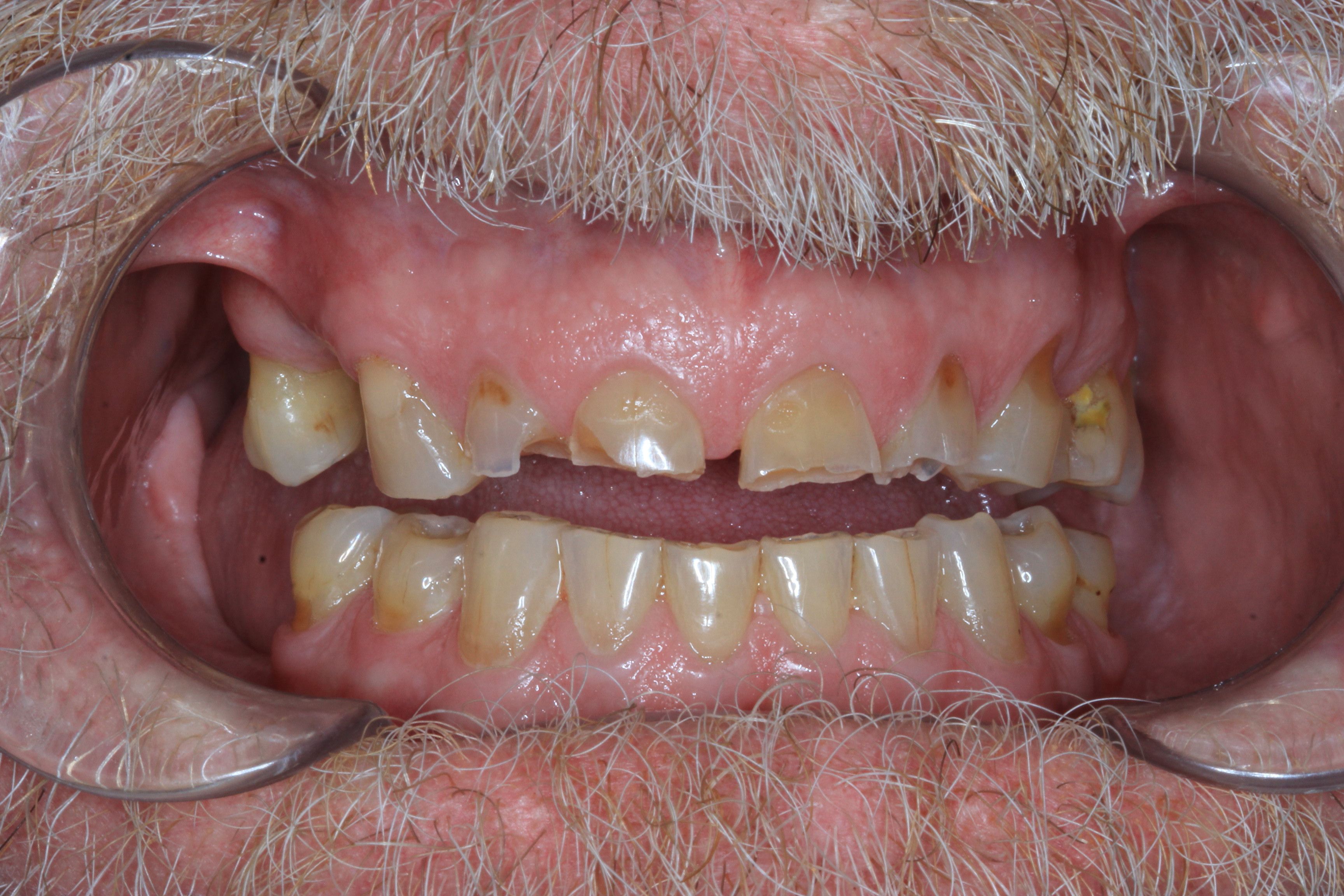 before composite bonding