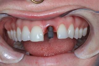 before implant