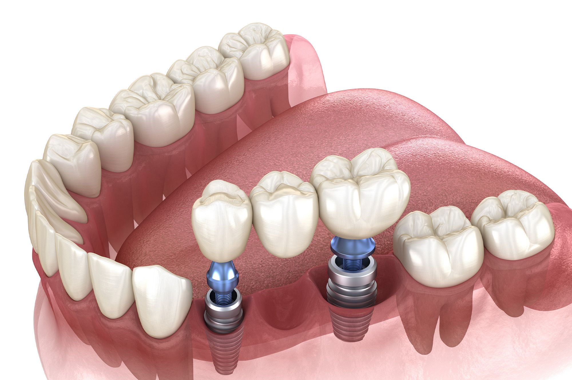 Multiple teeth