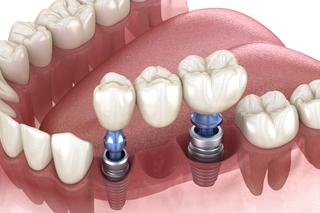 Implant-Supported Bridge